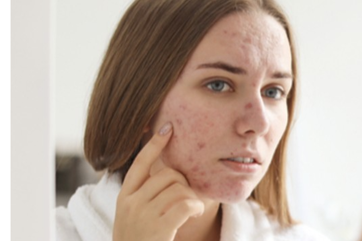 Young woman with acne 