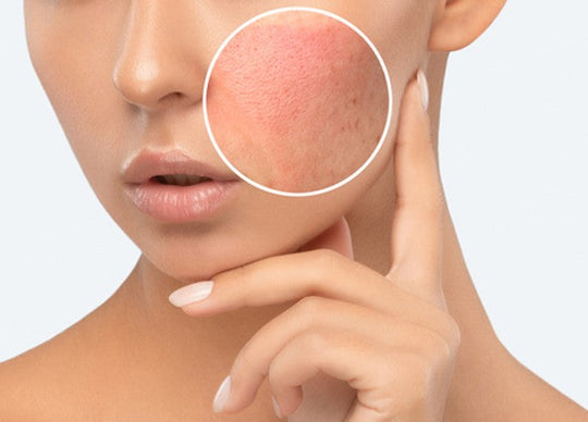 Face Mites Are Real: How to Get Rid of Them with This 3-Step Routine