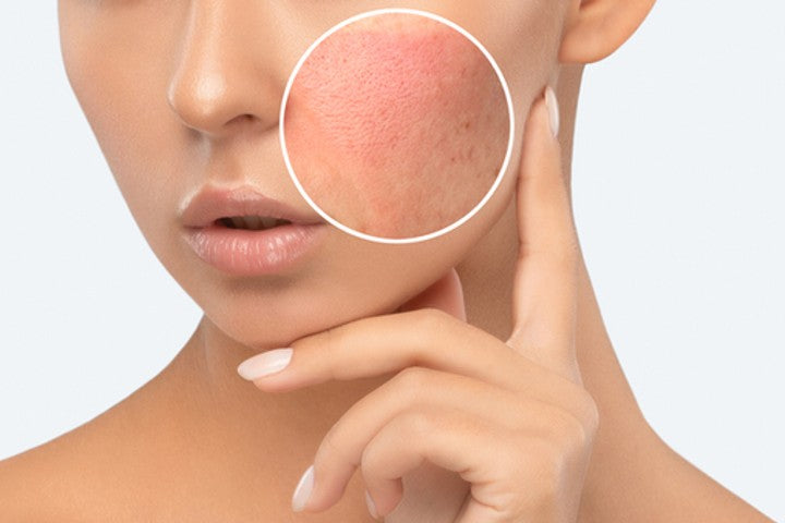 woman's face with zoom in circled red patch displaying face mites