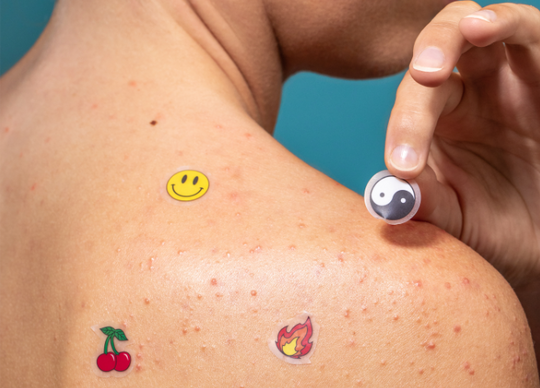 How to Get Rid of Shoulder Acne -- FAST