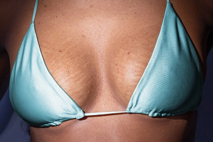 closeup photo of woman wearing blue bikini top with stretch marks on boobs 