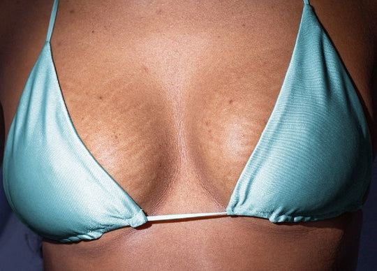 Stretch Marks on Boobs: The 3 Best Treatments