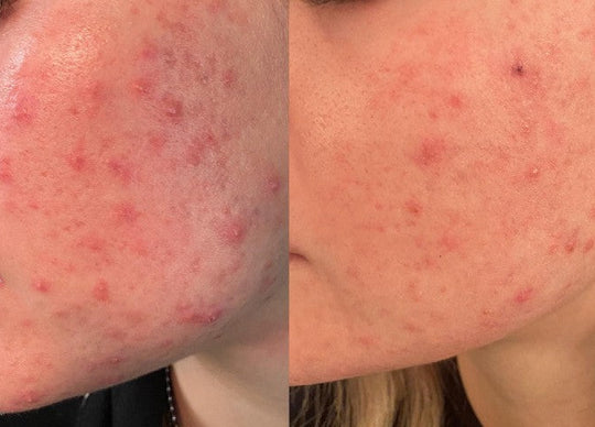 Is Your Skin Breaking Out or Purging?