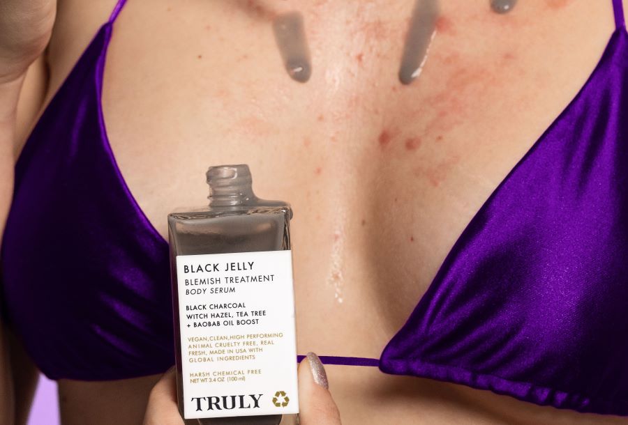 how to get rid of boob acne | closeup of woman's chest acne with black jelly treatment