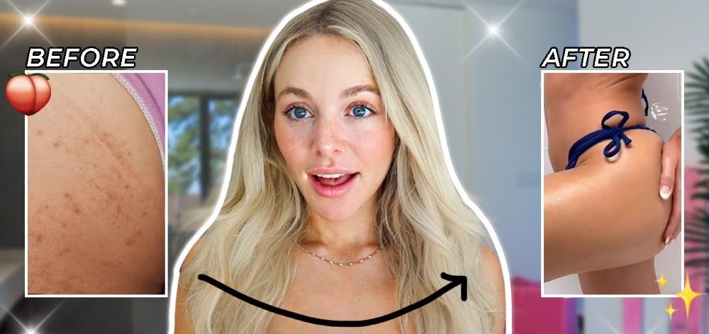 closeup of blonde haired woman with before and after photos of butt acne