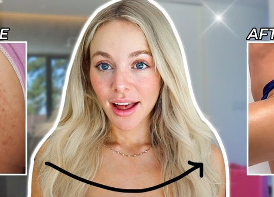 How to Get Rid of Butt Acne FAST