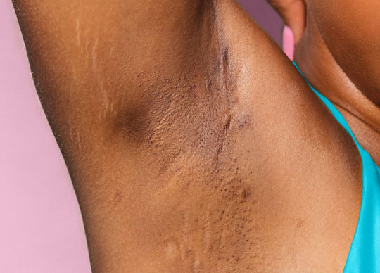 How to Get Rid of Dark Underarms: Armpit Brightening Routine