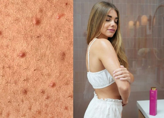 How to Get Rid of Keratosis Pilaris: A 2-Step Routine