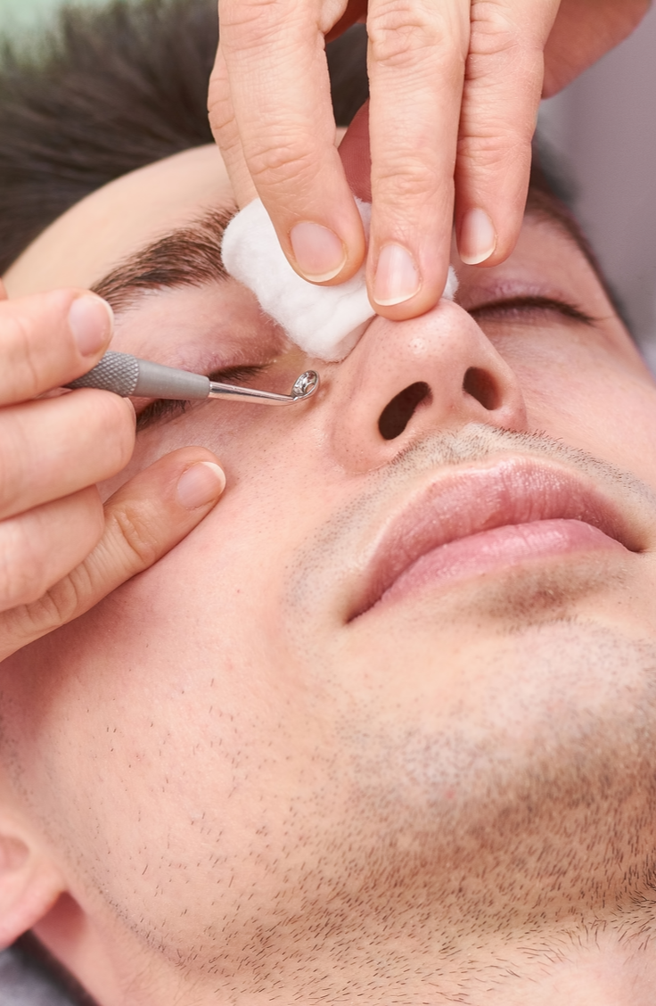 man getting blackheads removed with blackhead remover tool
