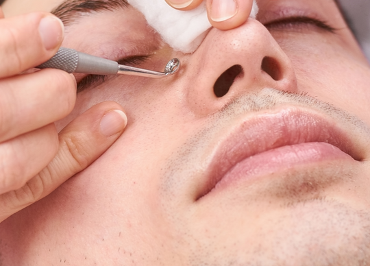 Natural Blackhead Remover Methods that Really Work