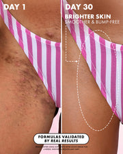 Side-by-side bikini area images show dark spots and bumps on Day 1. After 30 days using Truly Beauty’s Soft Serve After Shave Oil, skin appears smoother and brighter, with text emphasizing the visible improvement in ingrown hair treatment.