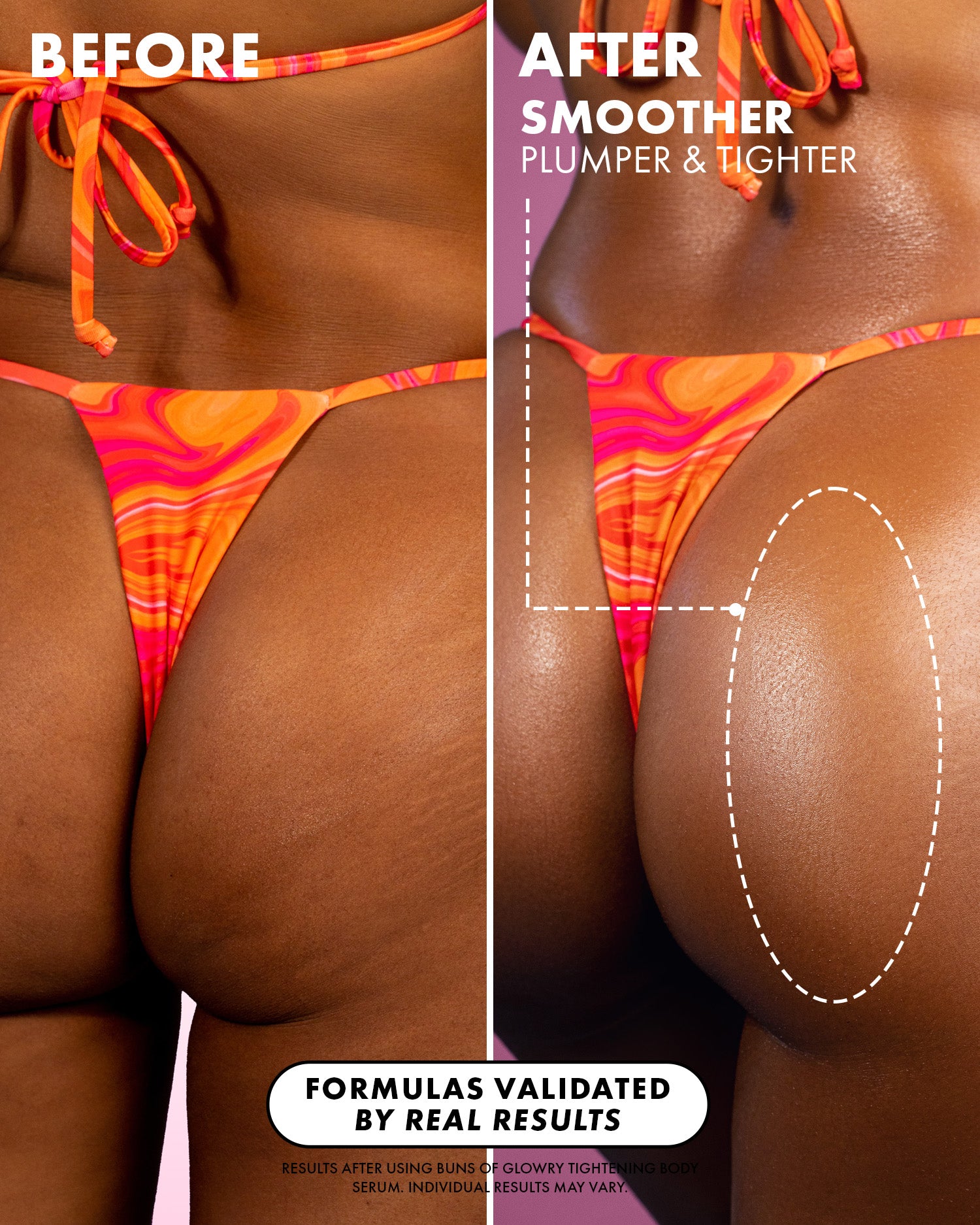 Side-by-side lower body comparison in a colorful bikini labeled Before and After. The After shows visibly smoother, plumper, tighter skin using Buns Of Glowry Tightening Body Serum by Truly Beauty.