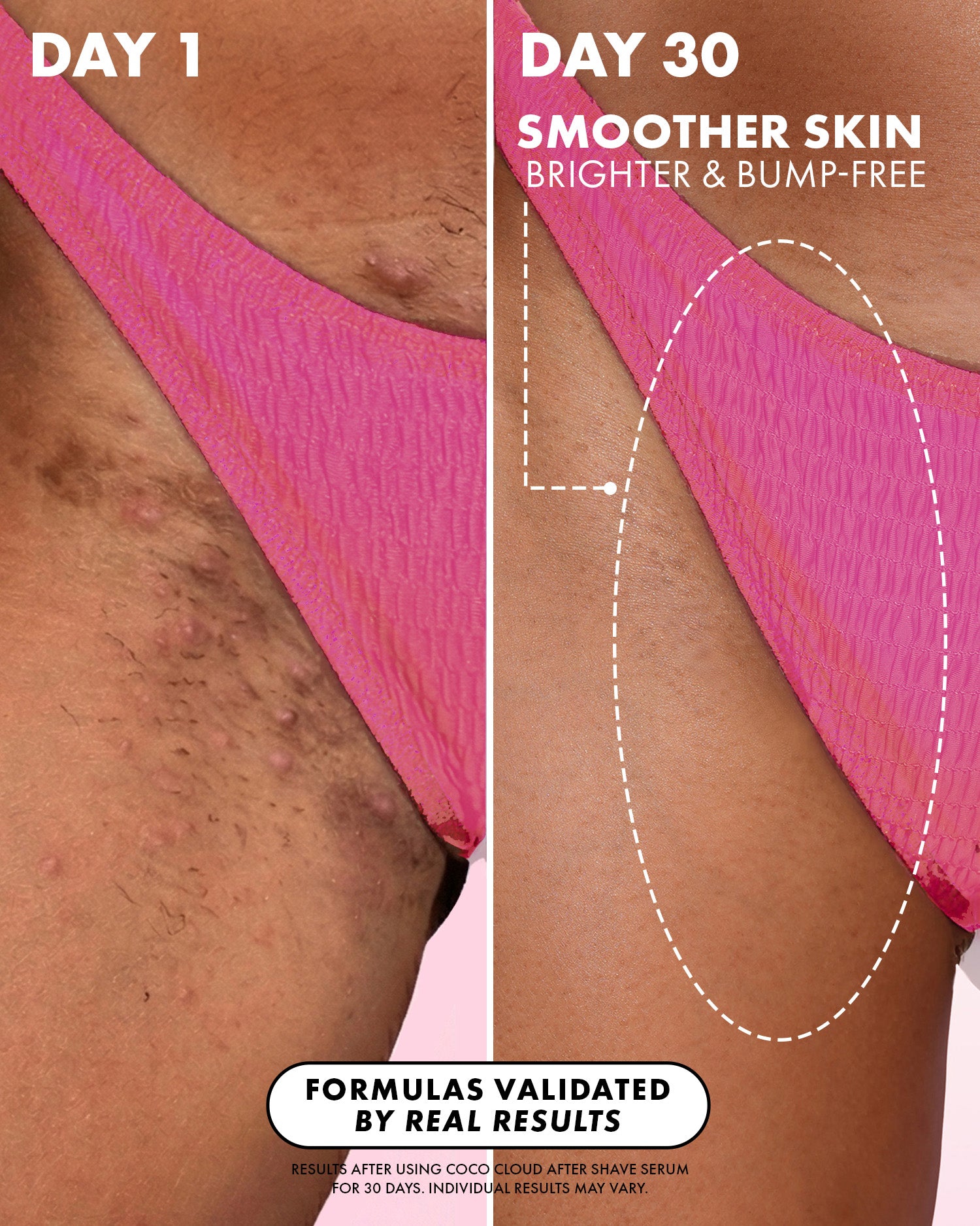Side-by-side close-up of a woman’s bikini line in pink bottoms: left shows bumps and uneven skin (Day 1); right is smoother after using Truly Beauty's Coco Cloud After Shave Serum for 30 days. Text highlights improved skin.
