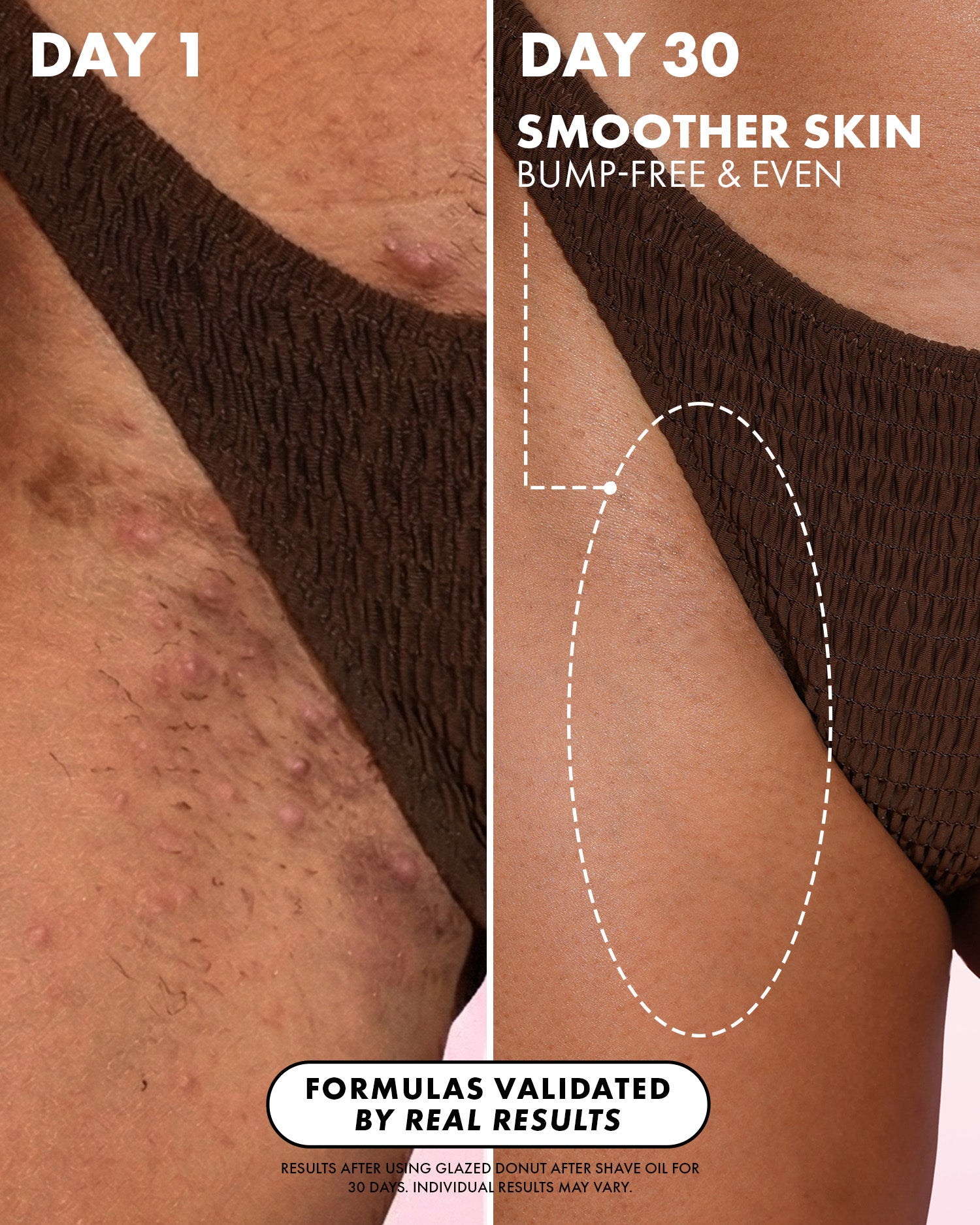 Close-up of hip skin using Truly Beauty’s Glazed Donut After Shave Oil. Left: Day 1—bumpy, red, ingrown hairs. Right: Day 30—smoother, even-toned skin. Text highlights validated results and post-shave hydration benefits.