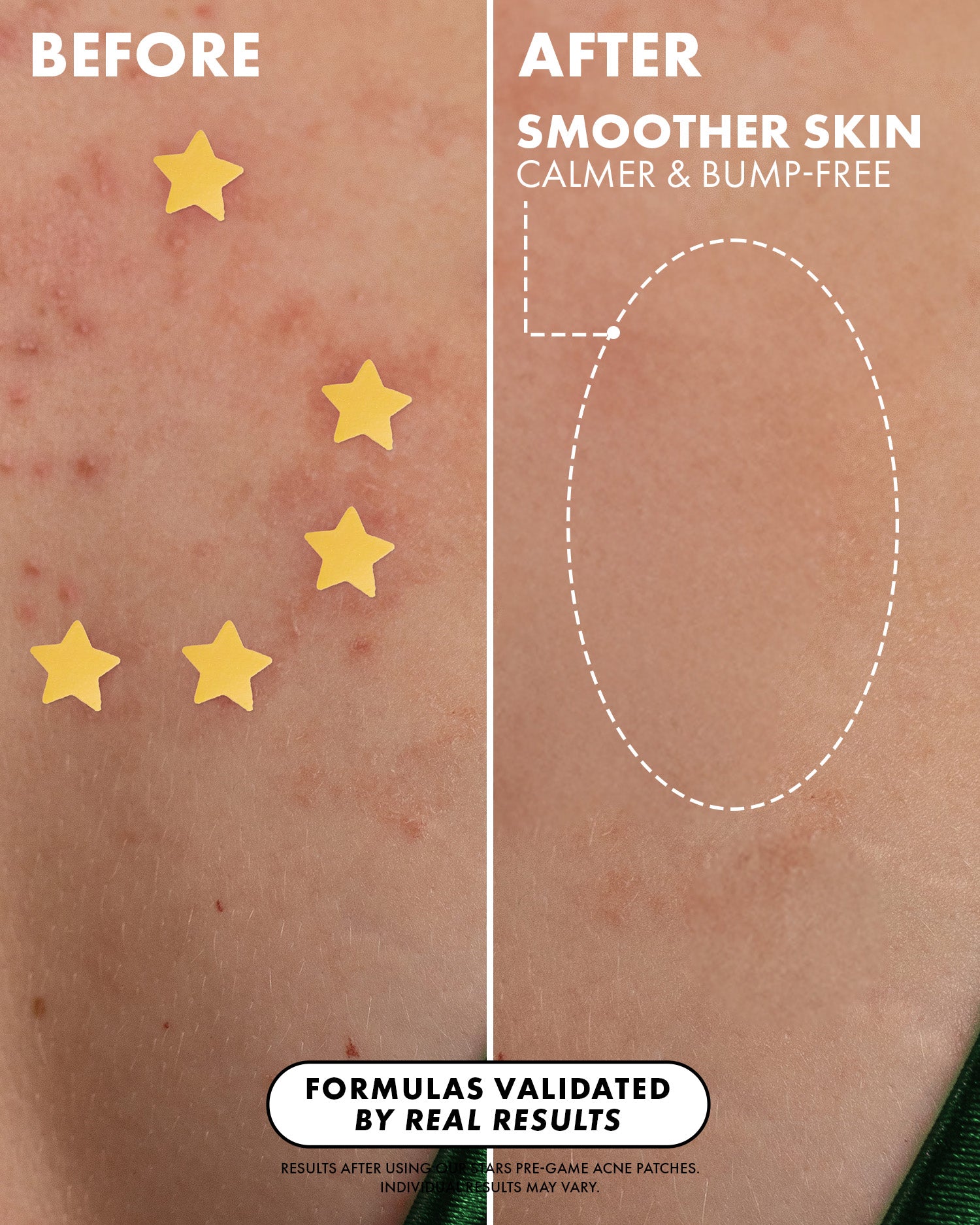 Split image shows skin before (red, bumpy with star patches) and after using Truly Beauty Our Stars Pre-Game Blemish Patches—smoother and calm. Text: Formulas validated by real results.