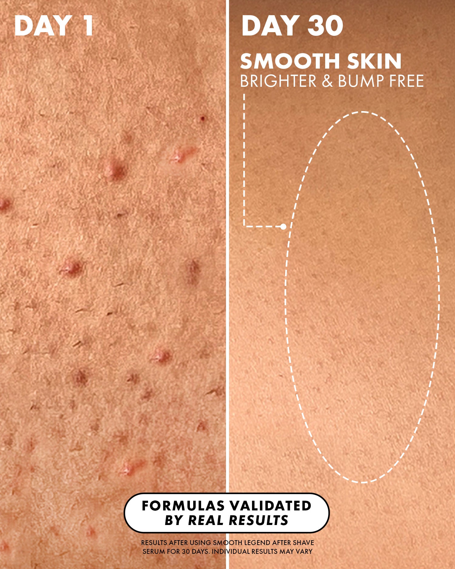 Split image: left side shows red, bumpy skin from Keratosis Pilaris labeled “Day 1”; right side shows smoother skin after 30 days using Truly Beauty's Smooth Legend After Shave Serum. Text: “Smoother, brighter, bump-free results—proven by real users.”.