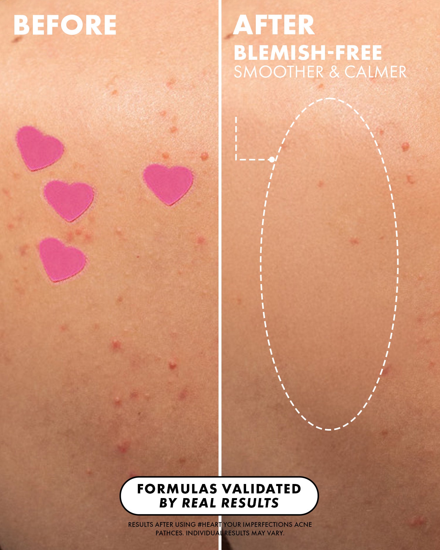 Close-up of skin with red blemishes and #Heart Your Imperfections Blemish Patches by Truly Beauty on one side, and smoother skin on the other. Text highlights validated hydrocolloid formulas and real results.