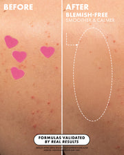 Close-up of skin with red blemishes and #Heart Your Imperfections Blemish Patches by Truly Beauty on one side, and smoother skin on the other. Text highlights validated hydrocolloid formulas and real results.
