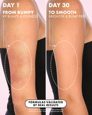 Side-by-side comparison of an arm: left, red and bumpy keratosis pilaris skin labeled Day 1; right, smoother skin at Day 30. Text highlights reduced bumps and redness after using Truly Beauty’s Smooth Legend After Shave Serum.