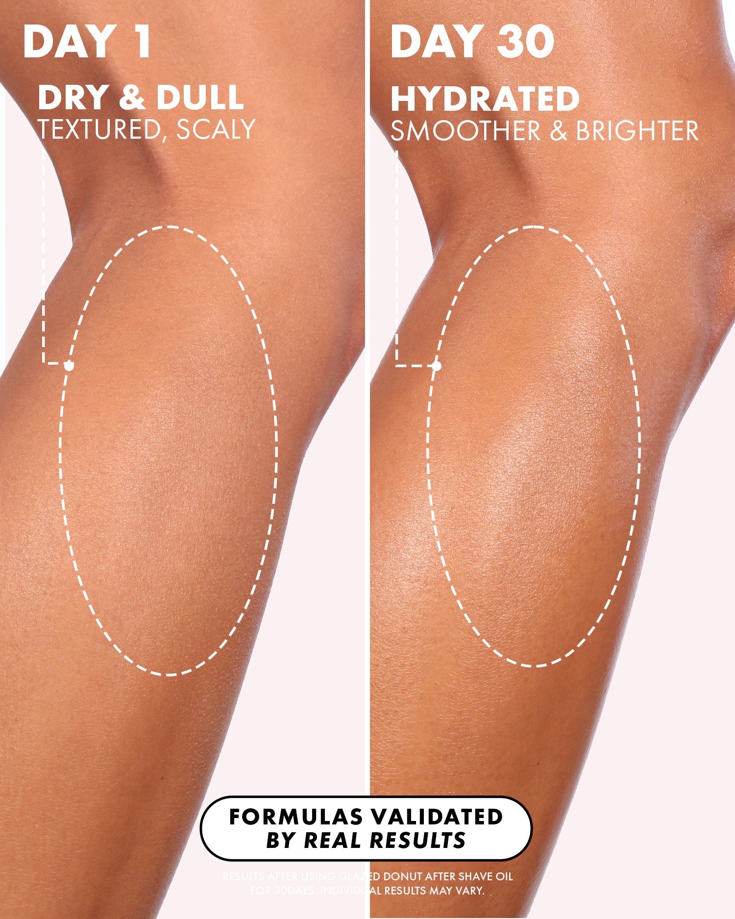 Close-up of a leg on Day 1 shows dull, textured skin, while Day 30 reveals hydrated, smoother skin after using Truly Beauty's Glazed Donut After Shave Oil—showing real post-shave hydration and visibly fewer ingrown hair concerns.