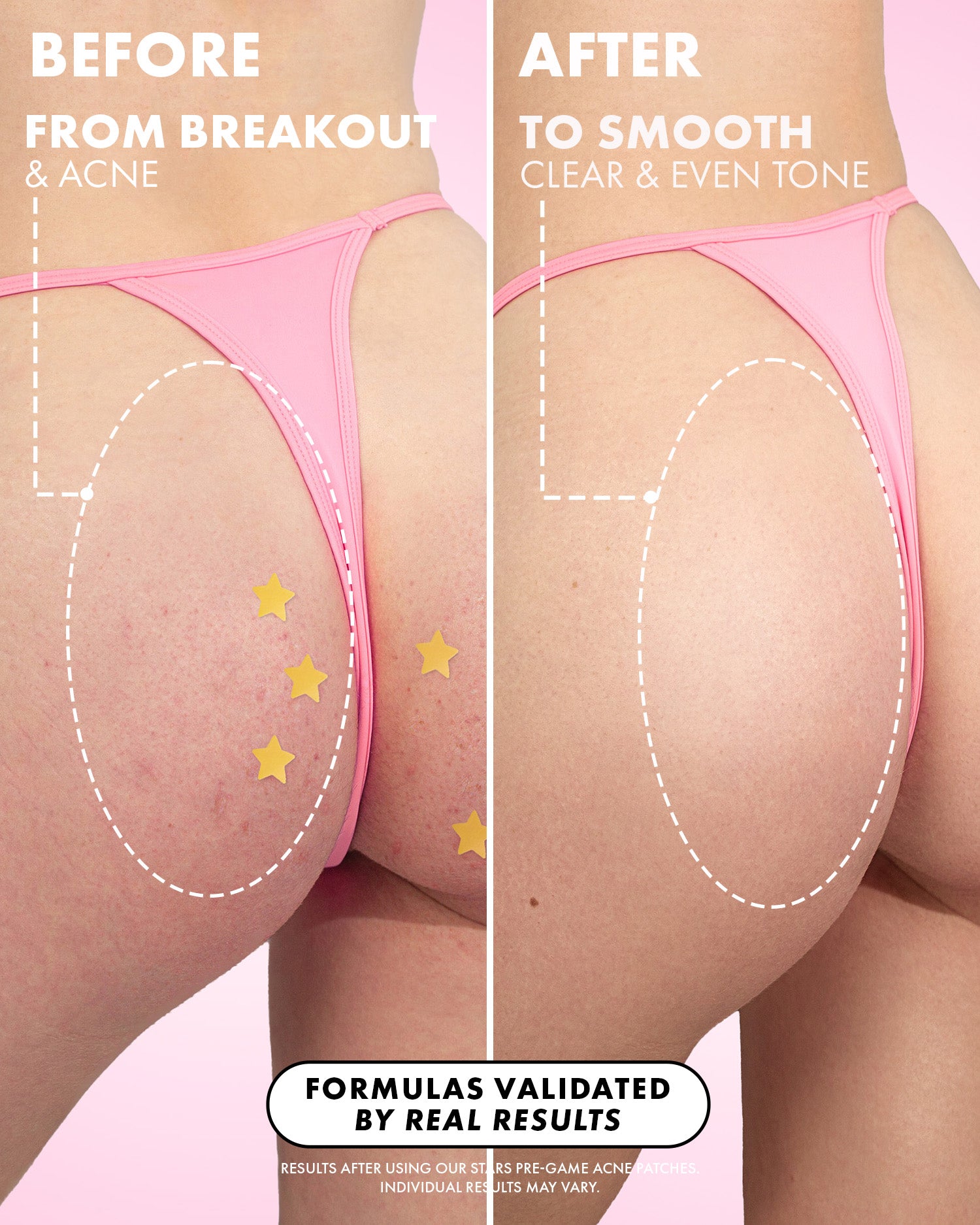 Side-by-side comparison of buttocks in pink underwear: left shows red acne spots labeled 