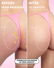 Side-by-side comparison of buttocks in pink underwear: left shows red acne spots labeled 