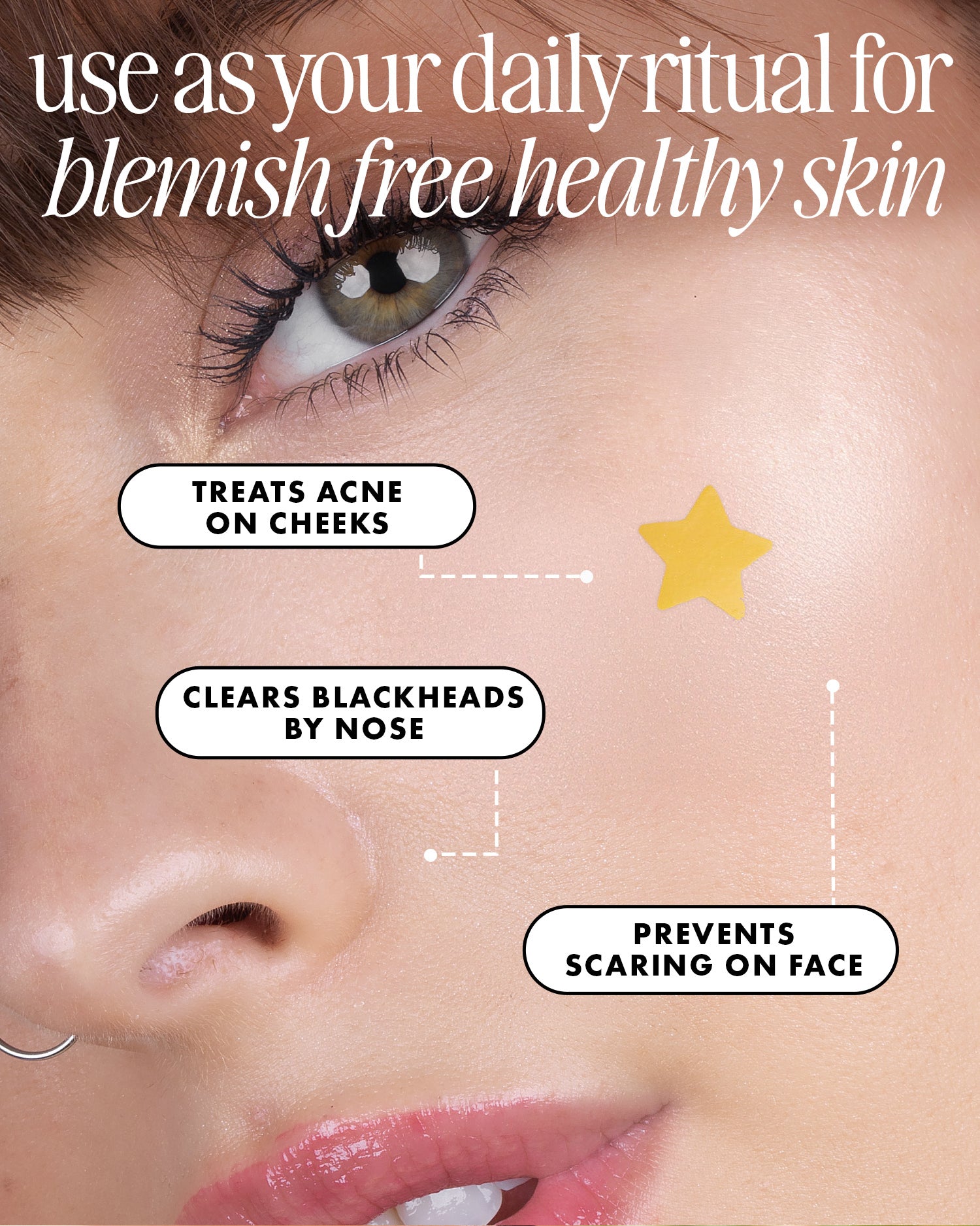 Close-up of a woman’s face with clear skin, wearing Truly Beauty’s Our Stars Pre-Game Blemish Patch on her cheek. Text highlights: treats cheek acne, clears blackheads near the nose, and helps prevent facial scarring.
