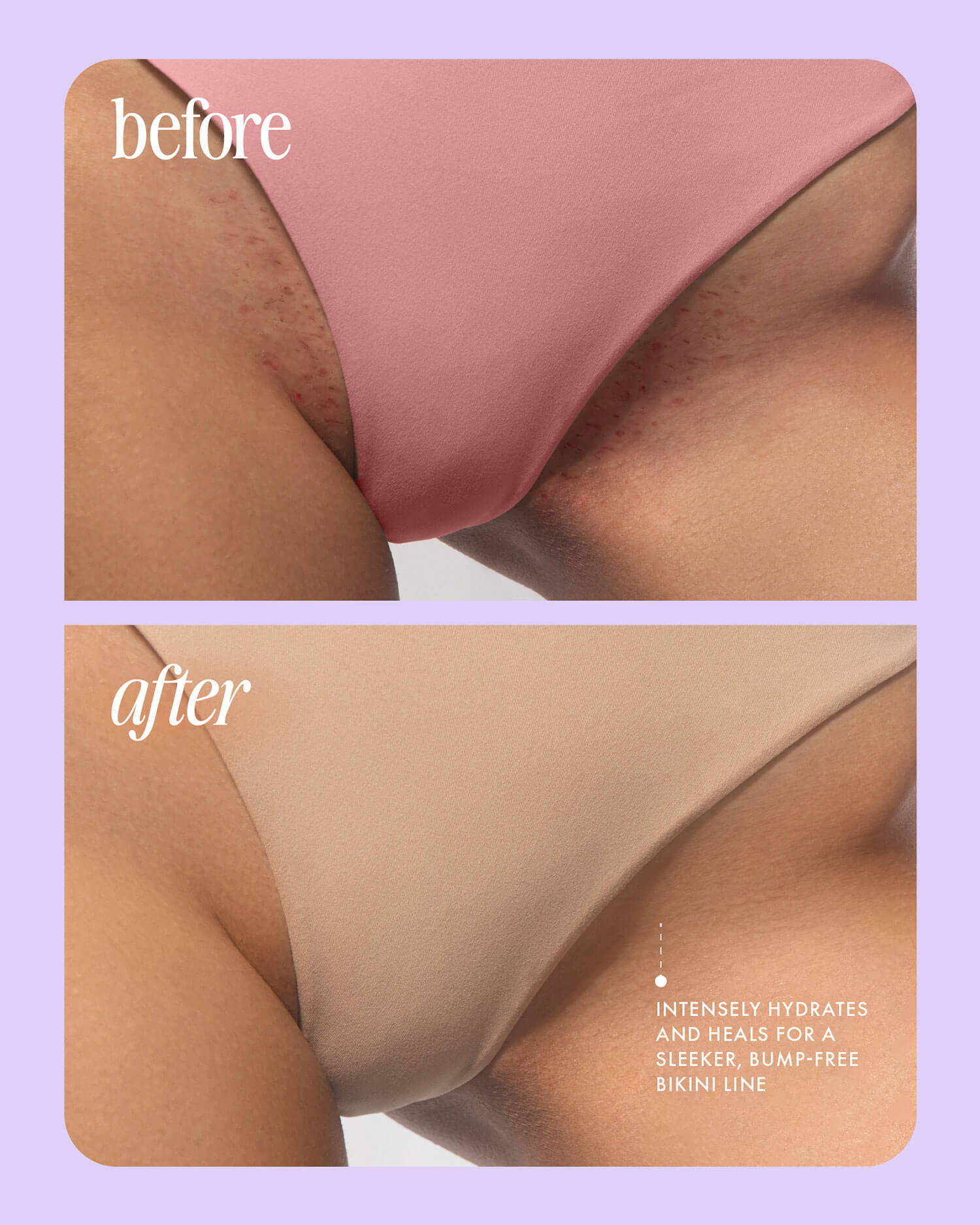 Close-up of a womans bikini line before and after using Glazed Donut After Shave Oil; the before image shows bumps and redness, while the after showcases smoother, even-toned skin from post-shave hydration that softens and soothes.