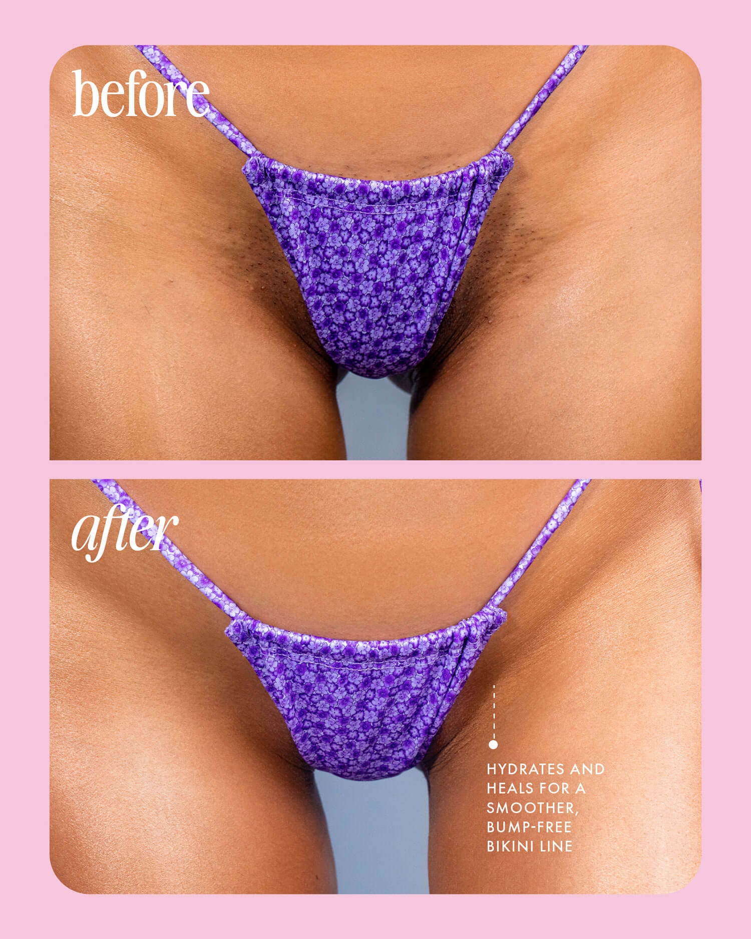 Close-up of a bikini line in a purple floral bikini bottom, shown before with ingrown bumps and after with smoother skin—text highlights hydration and healing benefits from soothing jojoba in Cooka Concentrate by Truly Beauty.