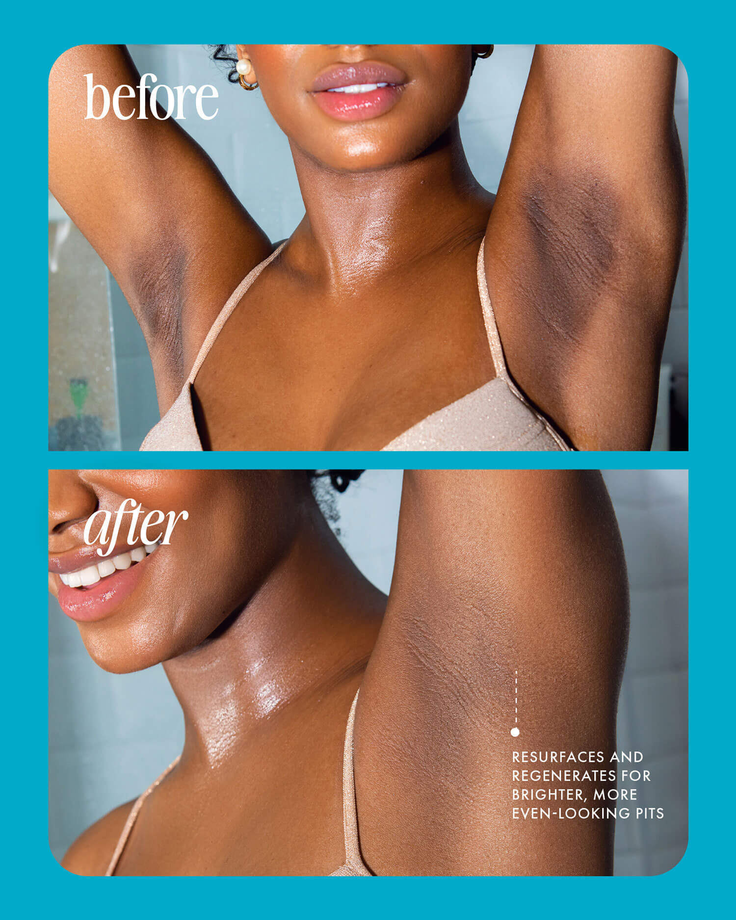 Split image of a woman's underarms: the top (“before”) shows dark, uneven skin; the bottom (“after”) is brighter and smoother, showing how Truly Beauty's Jelly Booster Pigment Body Potion helps resurface and even out underarm tone.