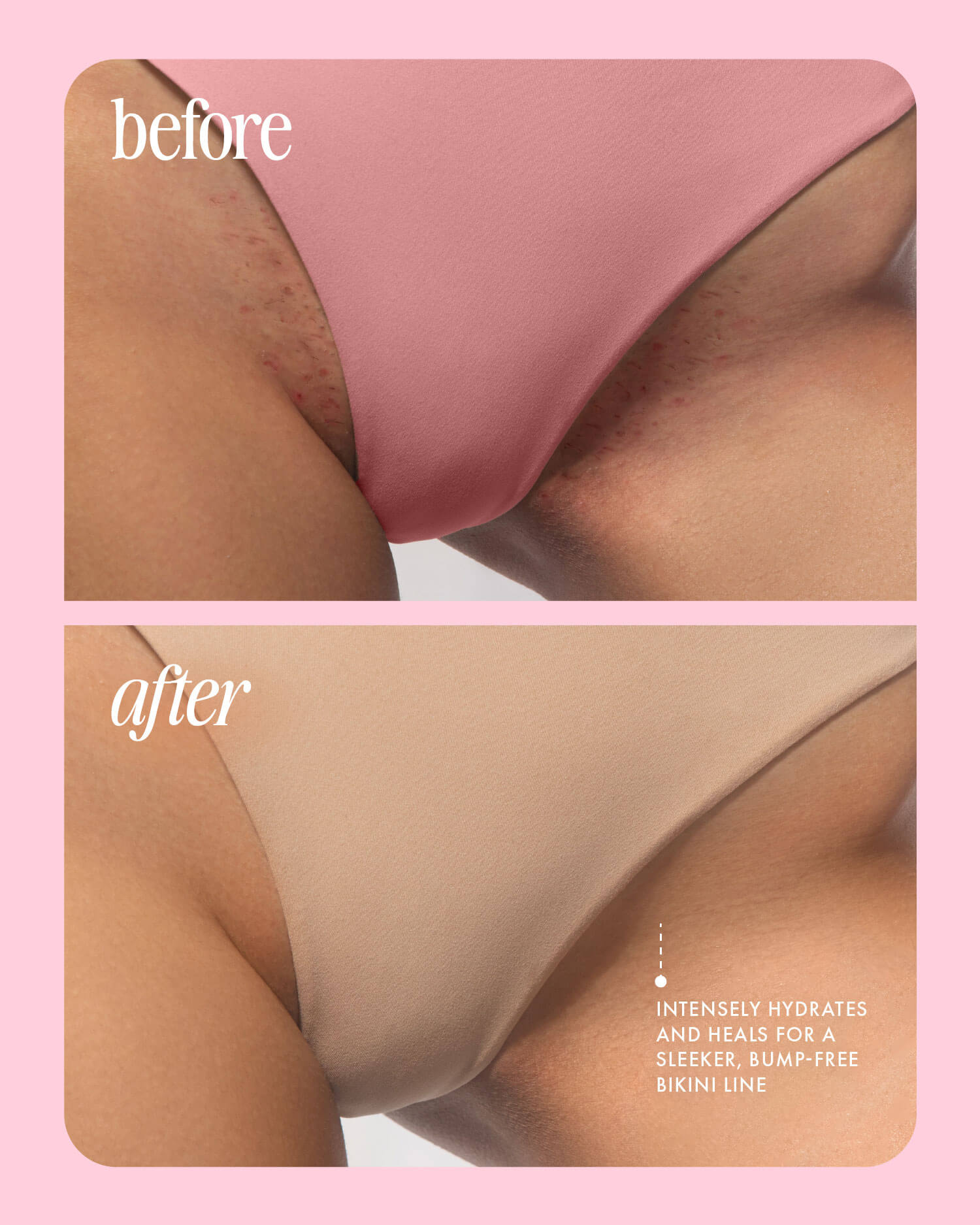 Two close-up images of a womans bikini line: the top (before) shows redness and bumps, while the bottom (after) is smooth and clear. Text highlights that Truly Beautys Smooth Legend Shave Routine hydrates, heals, and delivers a sleeker bikini line.