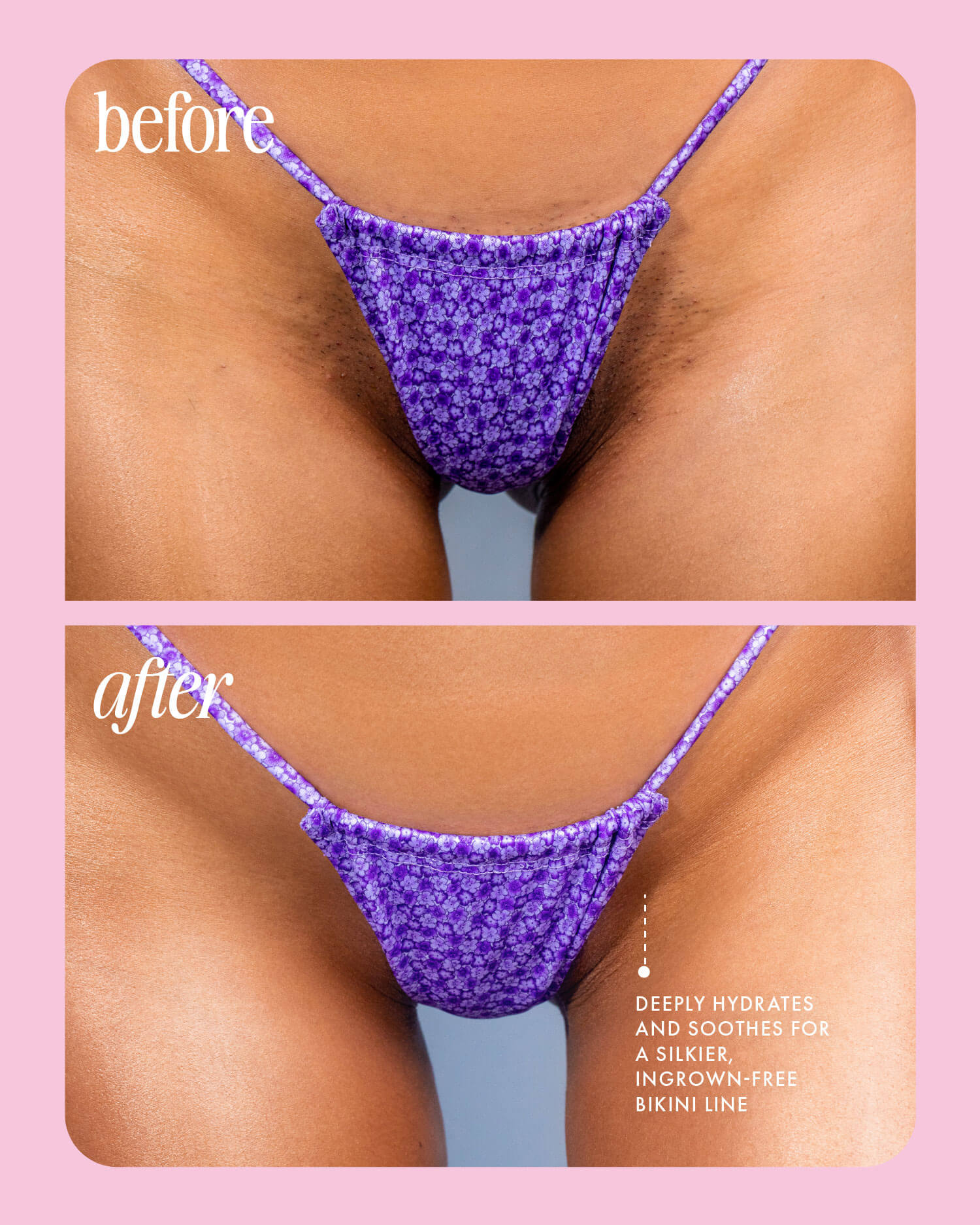 Before and after using Truly Beautys Cooka Routine on the bikini line: the before shows visible hair and texture; after reveals smoother, clearer skin. Text highlights hydration, soothing, and no ingrown hairs.