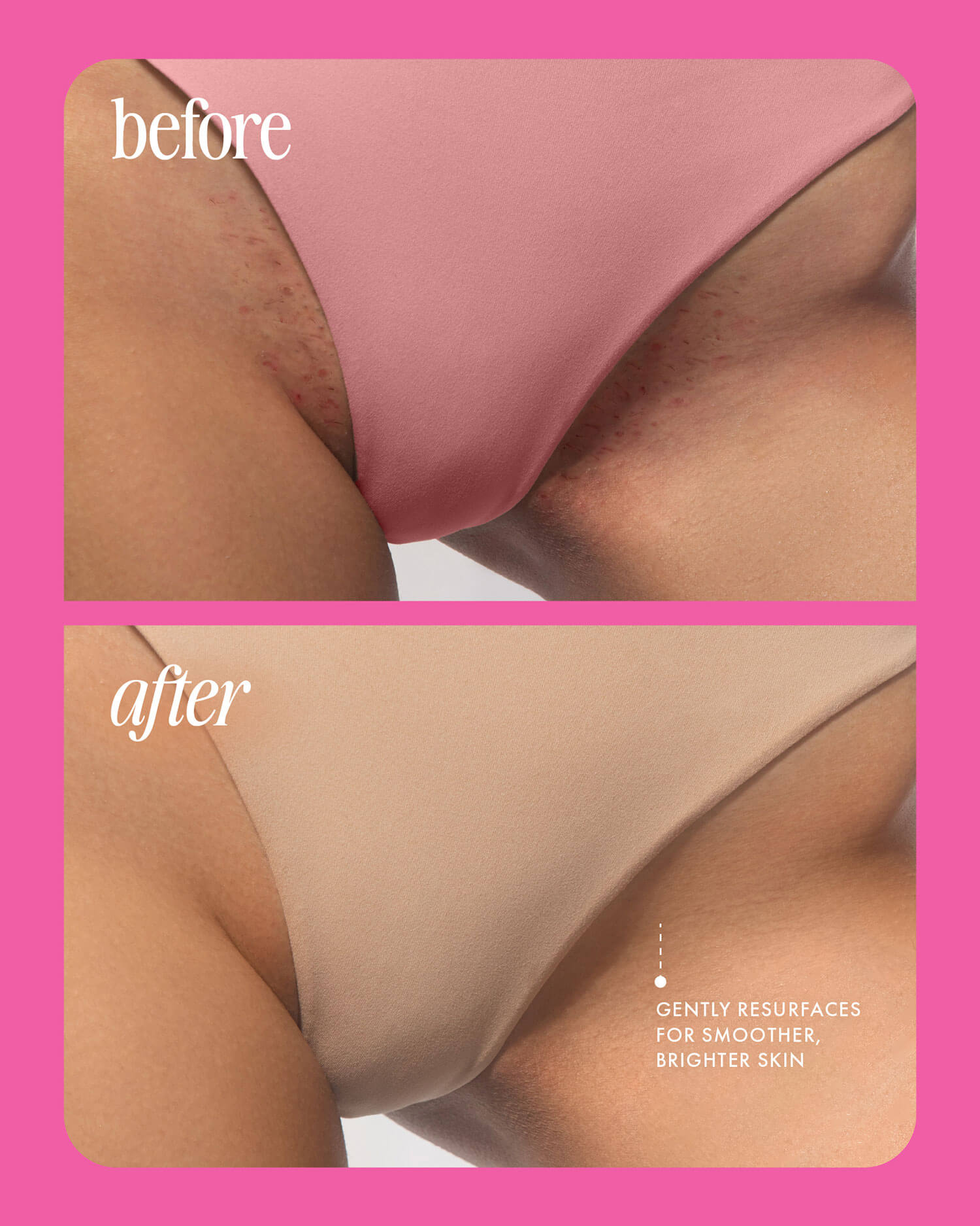 Split image showing a bikini area close-up: before with red bumps, after with smoother, glowing skin. Text reads: Gently resurfaces for smoother, brighter skin with Truly Beauty’s Smooth Legend Pre-Shave Scrub.