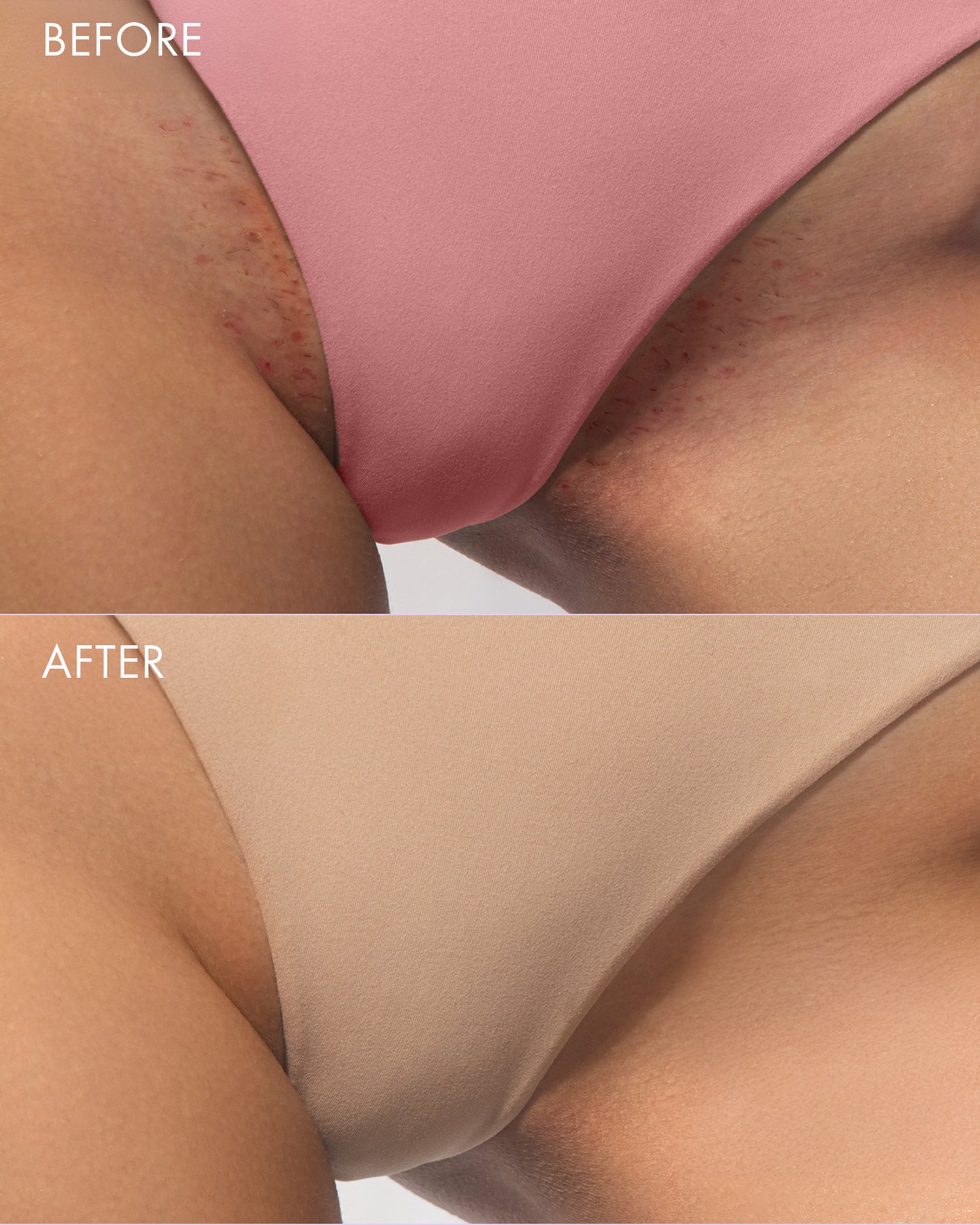 Split image labeled Before and After shows a bikini line transformation. Before: red bumps and irritation. After: smooth, even skin thanks to Truly Beauty Body Brightening Set.